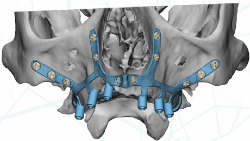 Diseño estructura subperióstica