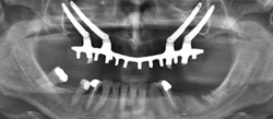 implantes cigomáticos