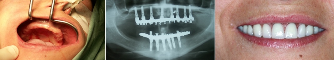Paciente desdentada total. Hueso muy estrecho. Implantes colocados sobre injertos óseos