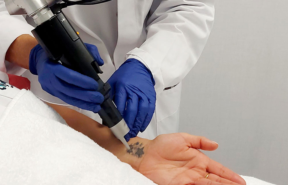 Eliminación de tatuajes - Dra. Calvo